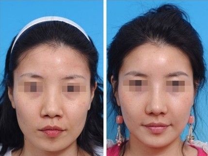 鼻尖成形術——趙小姐