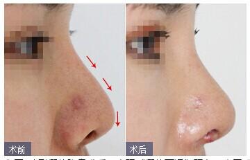 ?？诩袤w隆鼻.jpg