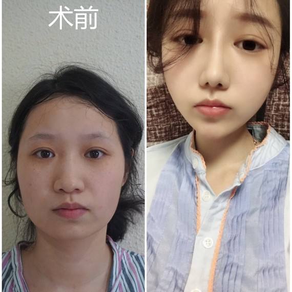 縮小鼻子.jpg