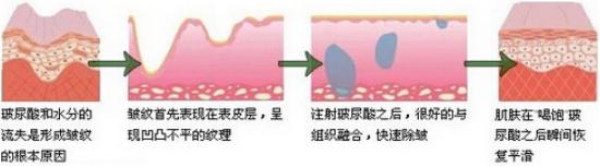 玻尿酸除皺.jpg