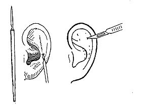招風(fēng)耳矯正術(shù).jpg
