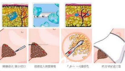 腹部吸脂術.jpg
