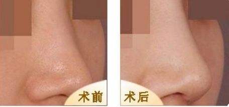 自體軟骨隆鼻后.jpg