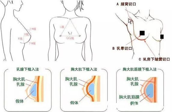 假體隆胸-林賢超