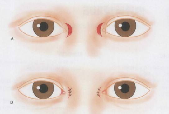 開(kāi)眼角術(shù)前.jpg