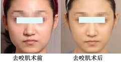 去咬肌整形手術——范女士