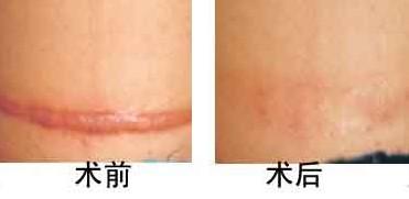 去疤痕.jpg
