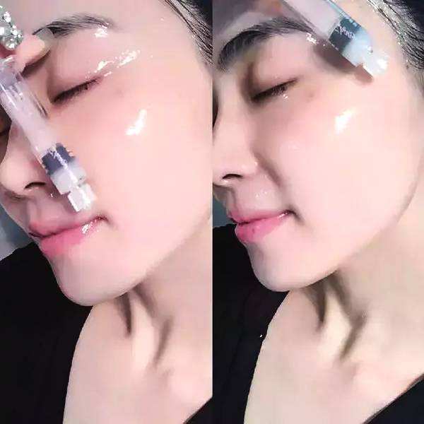 玻尿酸.jpg
