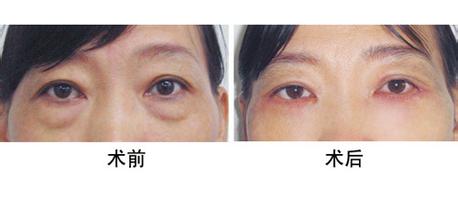去眼袋.jpg