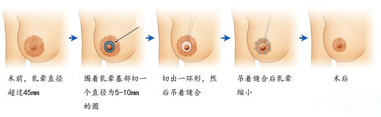 乳暈縮小手術.jpg