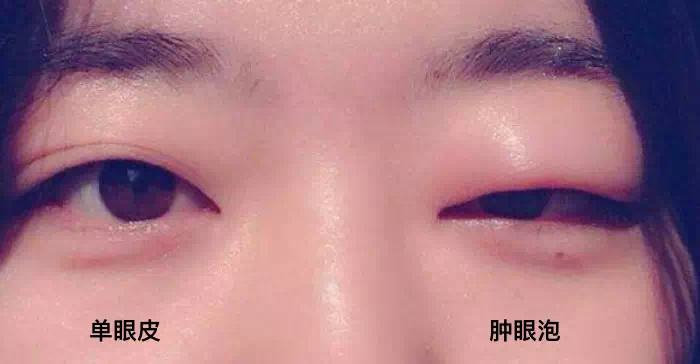 泡腫眼.jpg