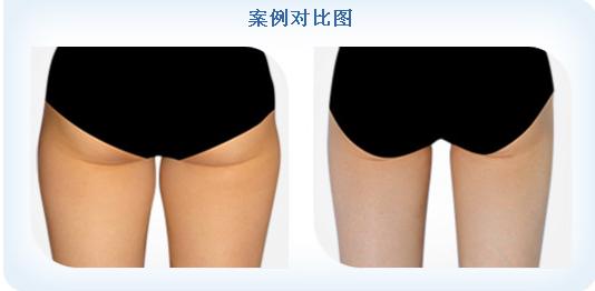 臀部吸脂手術(shù).jpg