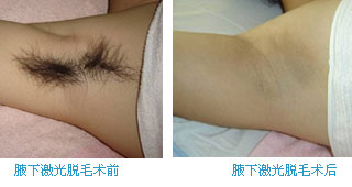 腋下激光脫毛術——劉先生