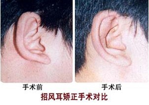 招風耳矯正術——李先生