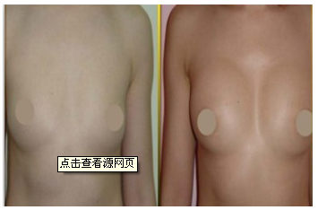 隆胸修復(fù).jpg
