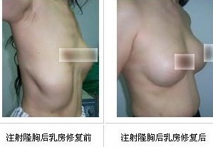 隆胸失敗修復成功案例——利女士