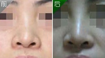 隆鼻手術失敗修復——劉小姐