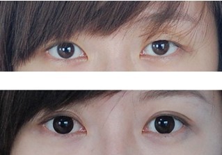 開眼角手術——鄭小姐