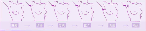 假體隆胸
